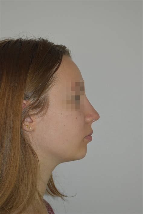 Avant Apr S Rhinoplastie G Nioplastie Du Docteur Martin