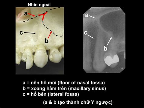 Gi I Ph U X Quang Trong Mi Ng Normal Intraoral Radiographic Anatomy Ppt