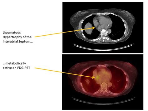 The Pump And The Tubes Lipomatous Hypertrophy Of The Interatrial Septum