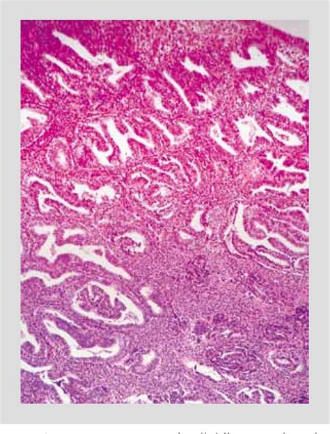 Figure 2 From A Case Of Endometrial Carcinoma Incidentally Treated With