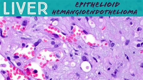 Rare Liver Tumor Epithelioid Hemangioendothelioma Basic Soft Tissue