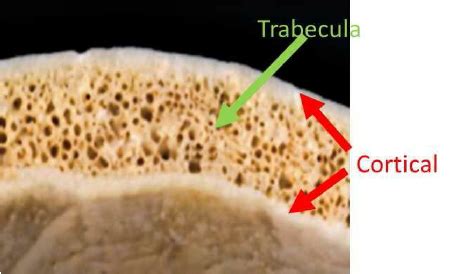 Skull Bone Inner And Outer Layer Is The Cortical Bone In Between Is