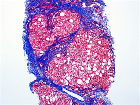 Pathology Outlines Chronic Hepatitis Grading Staging