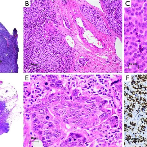 The Morphological Spectrum Of Large Cell Neuroendocrine Carcinoma