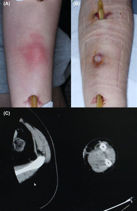 Subcutaneous Abscess As A Complication Of Postsex Reassignment Surgery