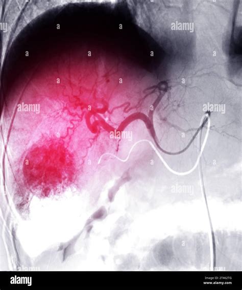 Transarterial Chemoembolization Tace Is A Medical Procedure Used To