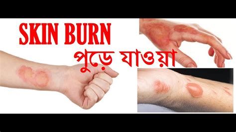 Burns Homeopathic Treatment Superficial Burn পুড়ে যাওয়ায়