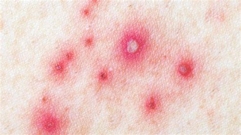 stages  shingles dermeleve dermeleve