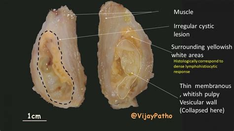 Pathology Of Cysticercosis Pathology Made Simple