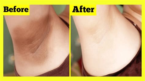 Top 10 Tips To Whiten Underarms In 20 Minutes Medy Life