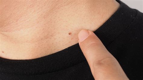 How Much Does Skin Tag Removal Cost GoodRx