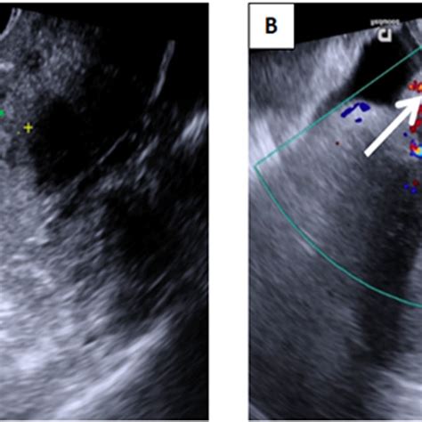 Transvaginal Grayscale Ultrasound Image Of The Uterus In Sagittal Plane