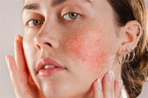 Skin School What Is Rosacea And How Can You Treat It Kate Kerr London