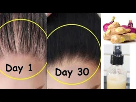 Magical Homemade Onion Ginger Juice For Double Hair Growth How To