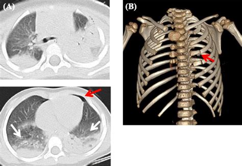 Comparison Of Two Pediatric Flail Chest Cases Scandinavian Journal Of Trauma Resuscitation