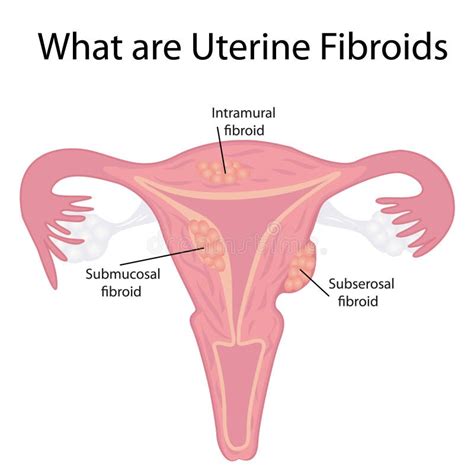 Diagram Of Subserosal Uterine Fibroids Stock Vector Illustration Of