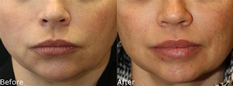 Juvederm Filler Dr Chernoff Plastic Surgery