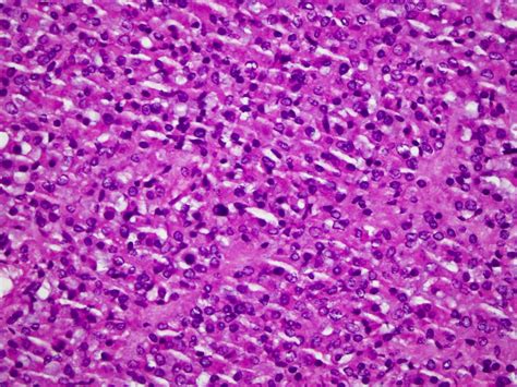 Pathology Outlines Gastrointestinal Stromal Tumor Gist