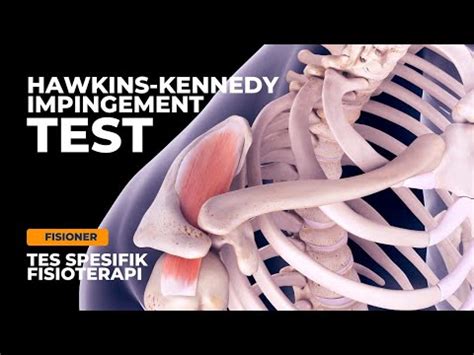 Hawkins Kennedy Impingement Test Peradangan Pada Otot Supraspinatus