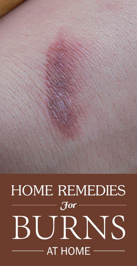 15 Home Remedies For Burns ideas | home remedies for burns, remedies ...