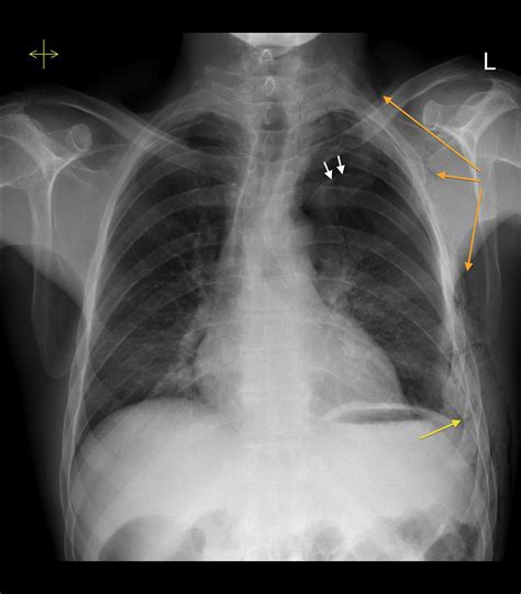 Tension pneumothorax due to rib fracture - Radiology at St. Vincent's