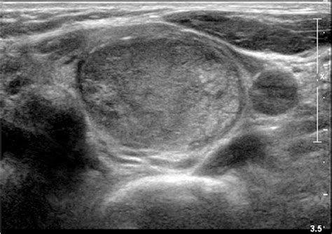 Figure 3 From Outcome Of Bethesda Iii Thyroid Nodules And Its