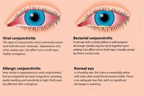 Conjunctivitis Or Pinkeye Symptoms And Treatments