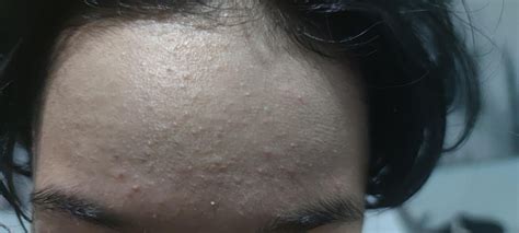 Bumps on forehead : r/DermatologyQuestions