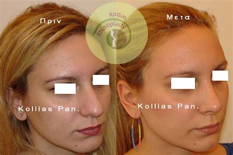 Rhinoplasty Broad Nose Tip 002 Π Κόλλιας