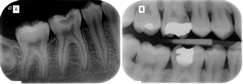 Caries Radiography