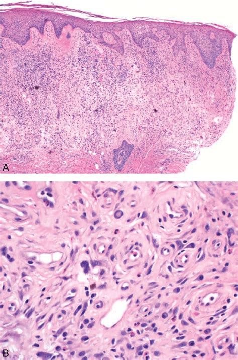 A Scalp Biopsy Demonstrating Epidermal Acanthosis With Spongiosis And