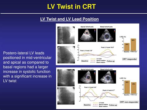 Ppt Left Ventricular Twist Mechanics In Heart Failure Powerpoint