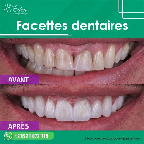 Facette Dentaire Tunisie Bas Prix Pose Facette Dentaire