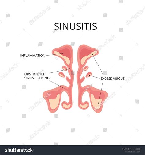 Inflammated Sinus Excess Mucus Obstrusted Sinus Stock Vector (Royalty ...