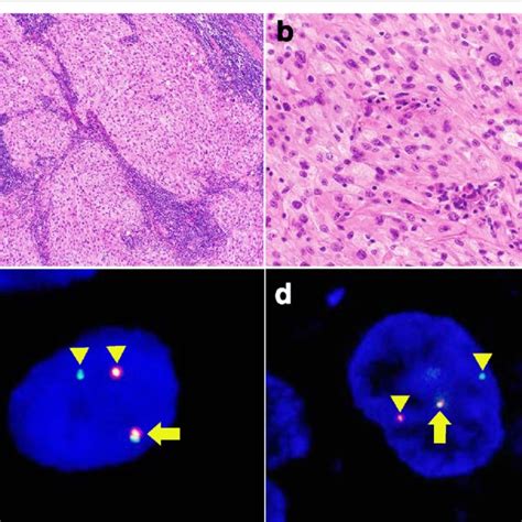 Pathological Findings Of CCSST With EWSR1 And CREM Rearrangements A