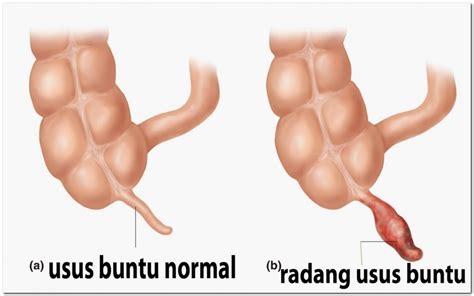 Pengertian Dan Cara Mencegah Penyakit Usus Buntu Atau Apendisitis