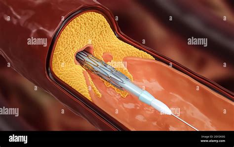 Coronary Stent Hi Res Stock Photography And Images Alamy