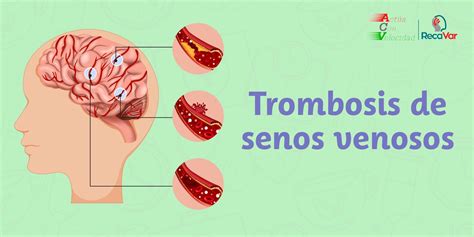 Trombosis De Senos Venosos 5 Aspectos Que Debes Aprender