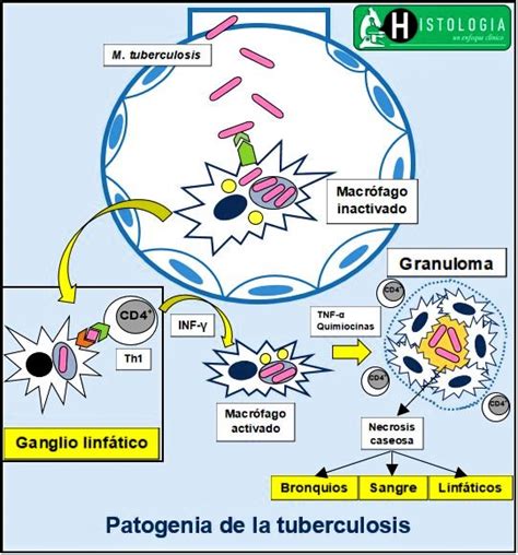 HISTOLOGÍA un enfoque clínico TUBERCULOSIS