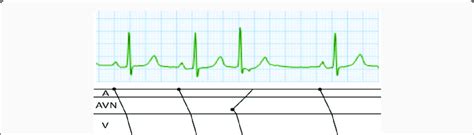 Conducted Junctional Extrasystole Ambulatory Ecg Recording At Mm S