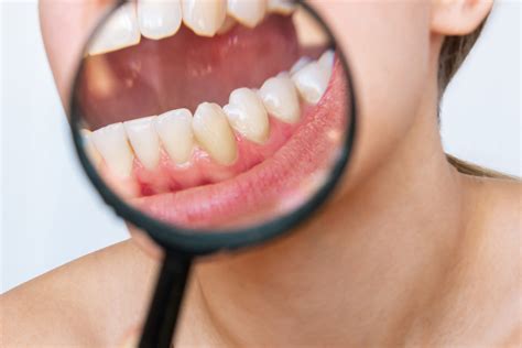 Qué pasa si tienes sarro síntomas y consecuencias del sarro dental