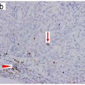 Immunohistochemical Detection Of Tumor Associated Immune Cells In