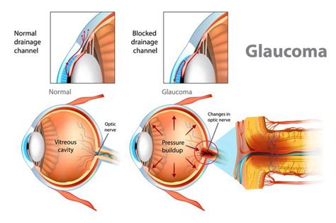 Causes Et Facteurs De Risque Du Glaucome Fmedic