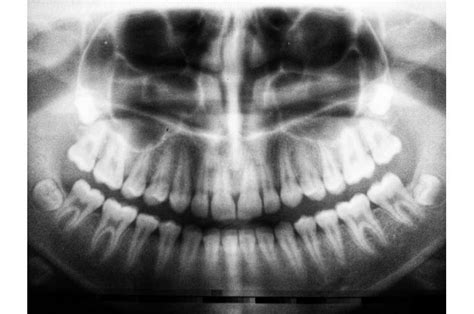 Ai Identifies Biological Sex Using Dental X Rays