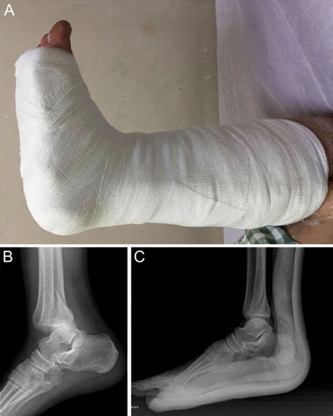 (A) Photograph of stabilization with short leg splint after closed ...