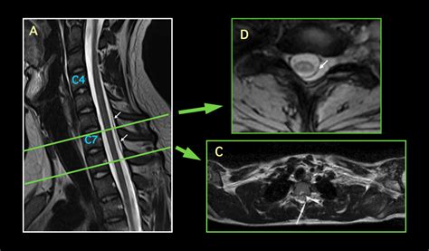 Brachial Plexus Mri Axial