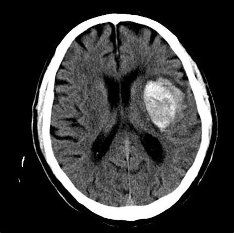 Signos Predictores En El Tc Cerebral Del Crecimiento Precoz De La