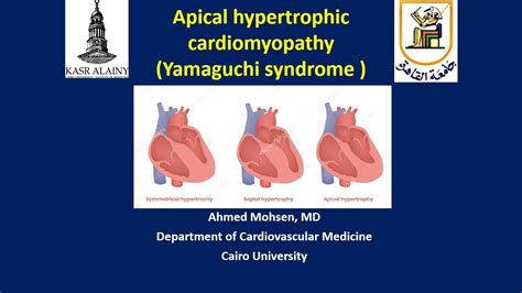 Apical Hypertrophic Cardiomyopathy Hcm Or Yamaguchi Syndrome Youtube