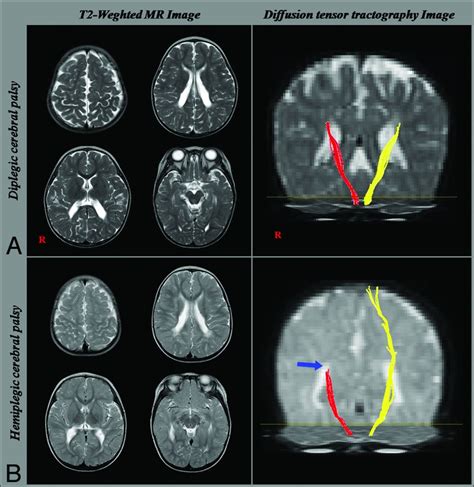 Cerebral Palsy Brain