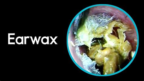 I Hope You Will Enjoy This Earwax Removal On Both Side YouTube